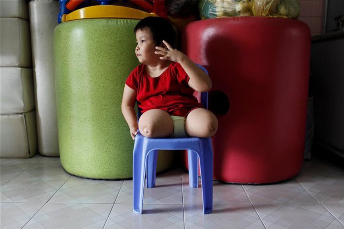 【高清图】 黑镜头 越战毒气残害下的畸形儿童图9